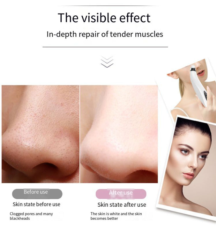 Electric Blackhead Remover Vacuum with Diamond Tip